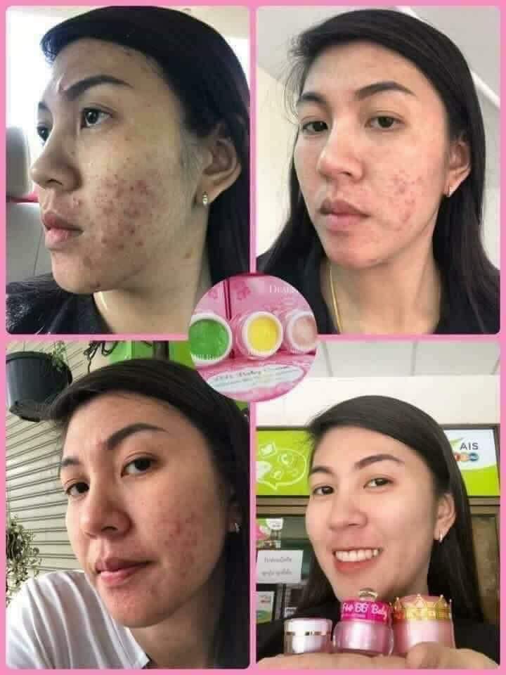 ครีมบีบีเบบี้ BB BABY CREAM ครีมหน้าใส ไร้สิว ชุดครีม5กรัม