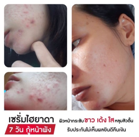 2แถม2 เซรั่มHyadaไฮยาดา โก-วีซี วิตามิน 2ขวด แถมฟรี เจลอโลน้องนะคะ1ซอง+สบู่คอลลาเจน1ก้อน