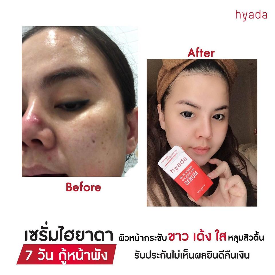 เซรั่มHyadaไฮยาดา โก-วีซี วิตามิน 1ขวด