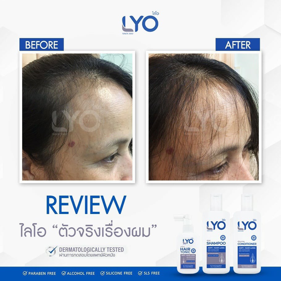 ไลโอ LYOผลิตภัณฑ์บำรุงผมหนุ่มกรรชัย ชุด1แถม2 แฮร์โทนิค+แชมพู +ครีมนวด ยาสระผมลดการหลุดร่วงของเส้นผม