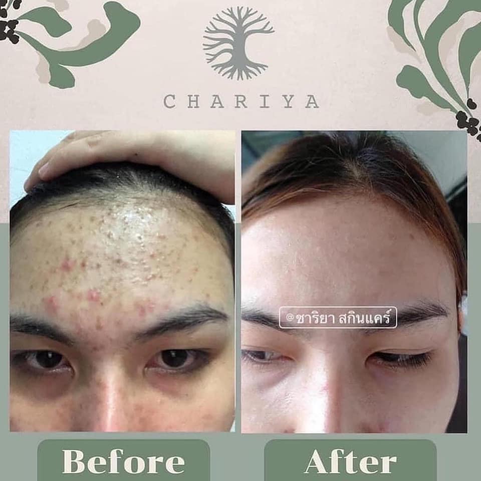 สบู่ใบบัวบก ชาริยาchariya ลดสิวหน้าใสของแท้100% ผิวแพ้ง่ายใช้ได้
