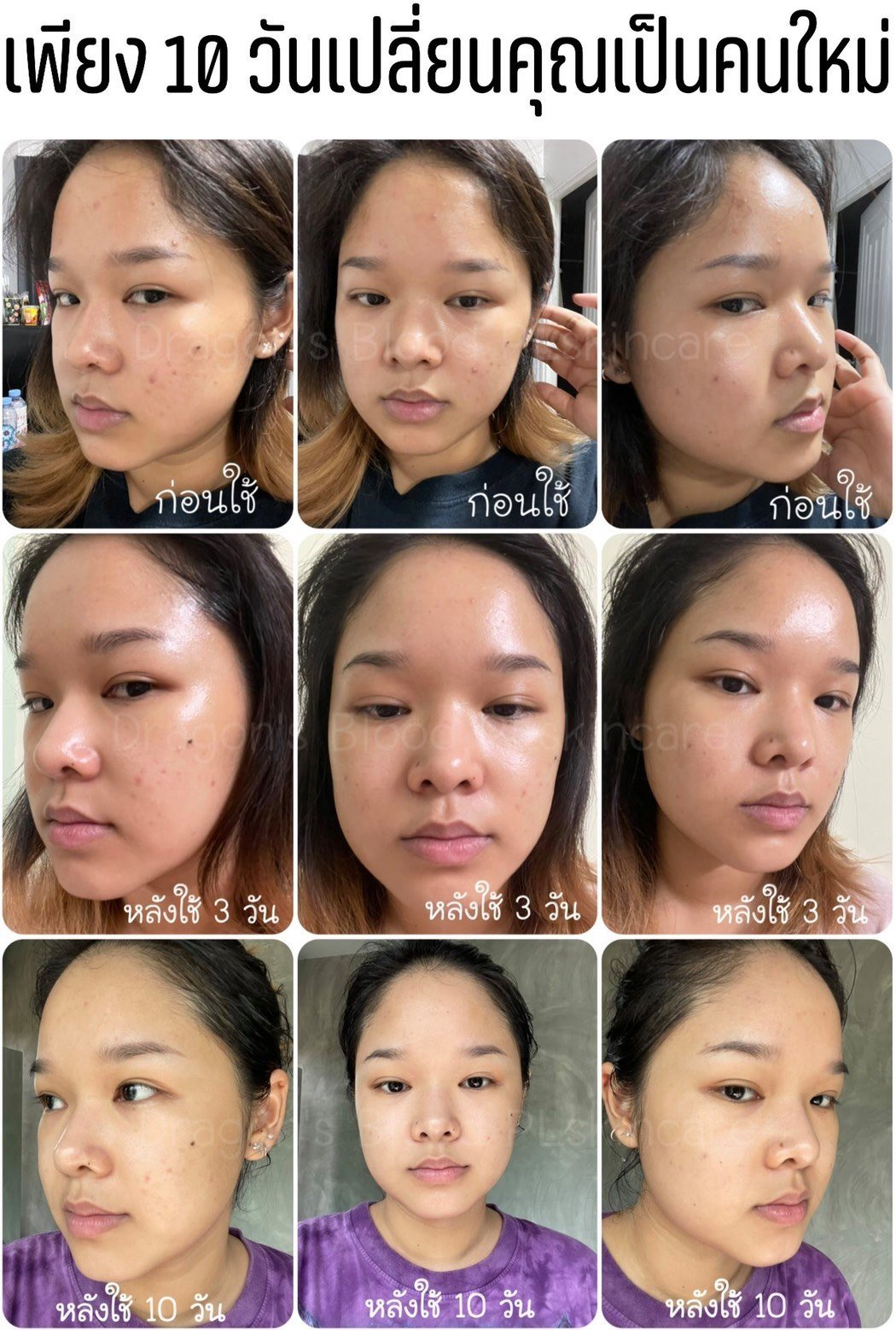 เซรั่มเลือดมังกรDragon’s Blood Acne Serumสูตรออร์แกนิค ผิวแพ้ง่ายใช้ได้