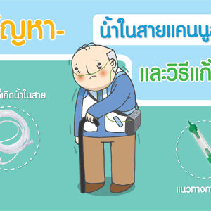 5 วิธีป้องกันน้ำขังในสายออกซิเจนแคนนูล่า (Cannula)